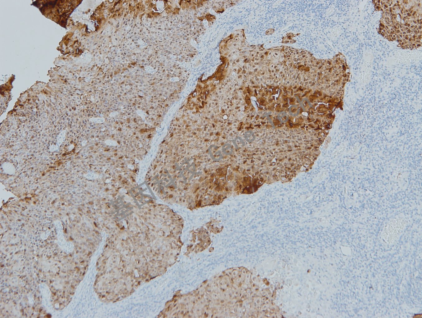 20190528-15 P16 O6 宫颈癌-2_副本.jpg