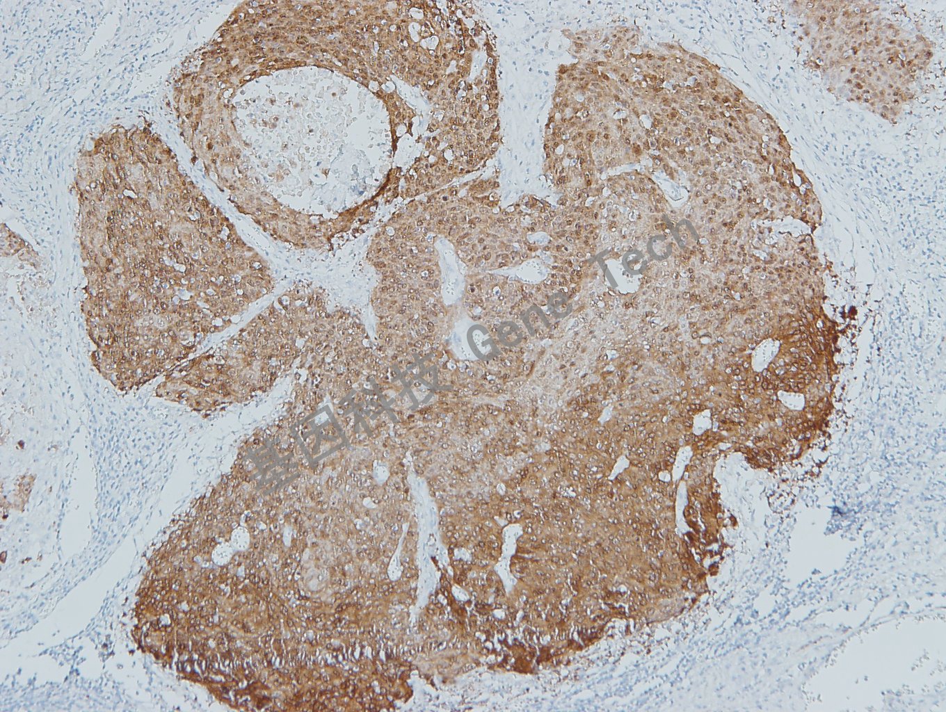 20190528-15 P16 O6 宫颈癌-3_副本.jpg