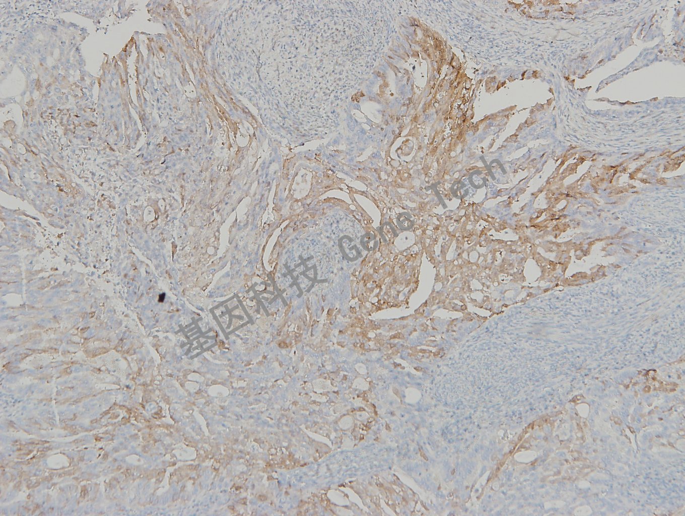 20190528-17 N2 子宫内膜癌-1_副本.jpg