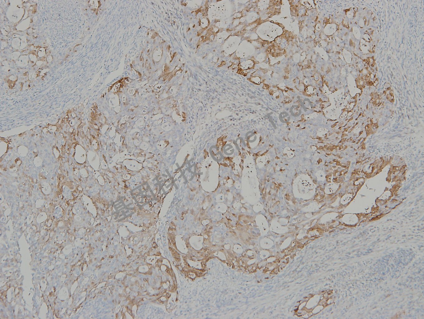 20190528-17 N2 子宫内膜癌-2_副本.jpg