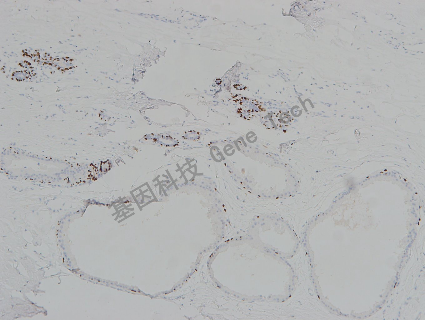 20190313-19 P63-T 乳腺阳-1_副本.jpg