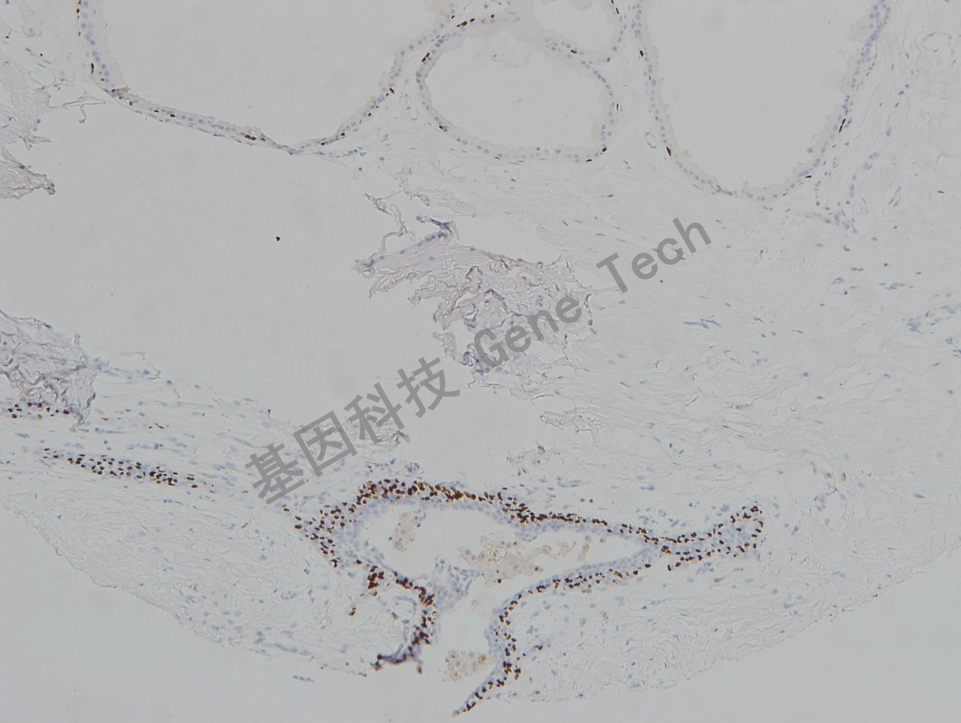 20190313-19 P63-T 乳腺阳-2_副本.jpg