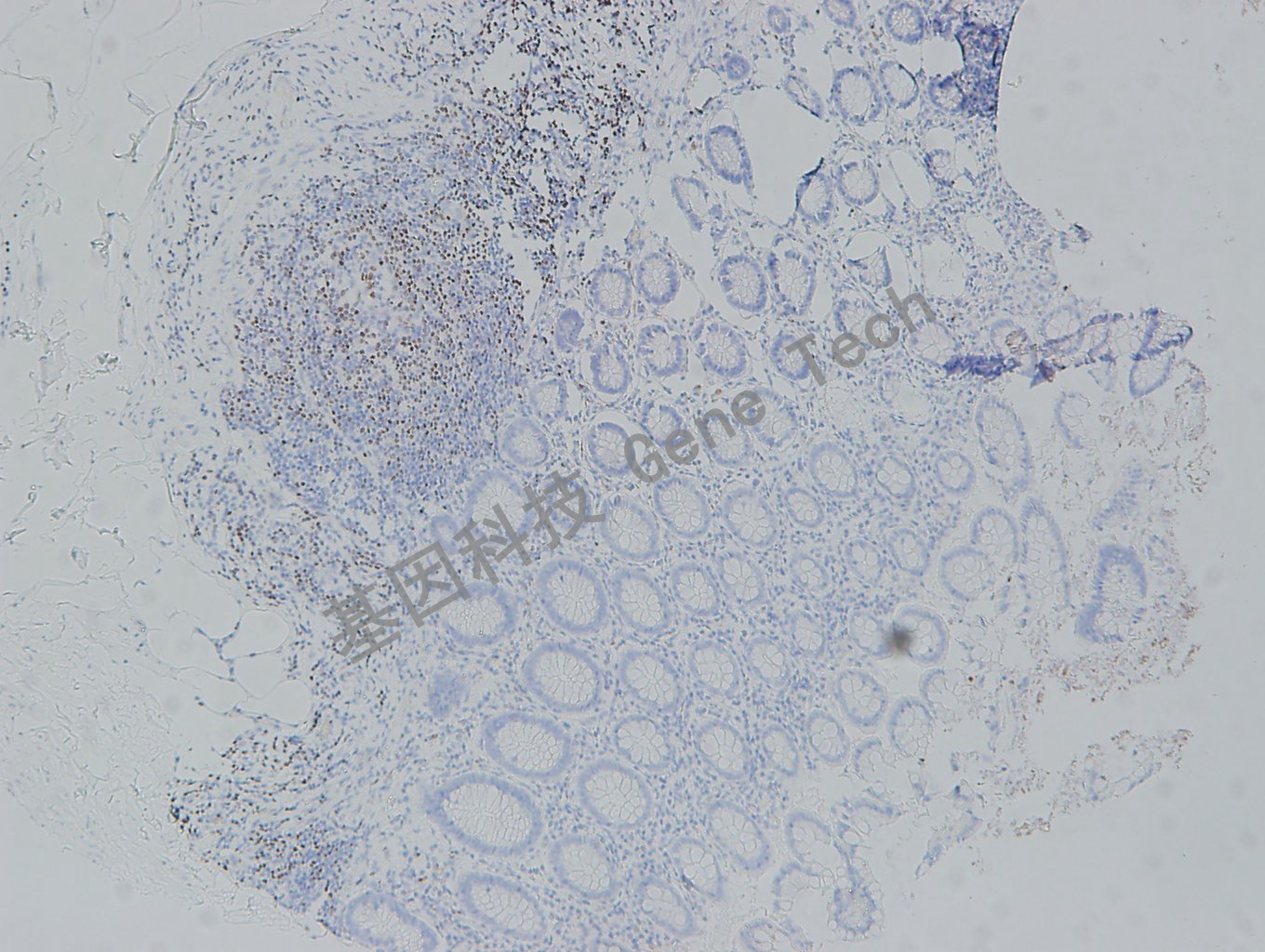 20180614-23 07-T21 阑尾_副本.jpg