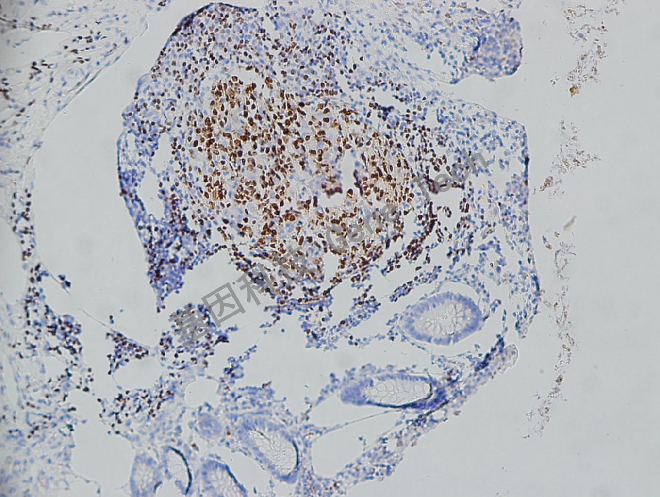20180614-23 07-T21 阑尾-2_副本.jpg