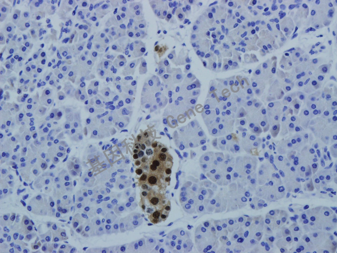 PAX-6 GT2278 40X 胰腺癌50_副本.jpg