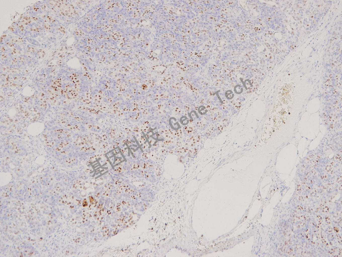 20180130-16 06-T4 胰腺_副本.jpg