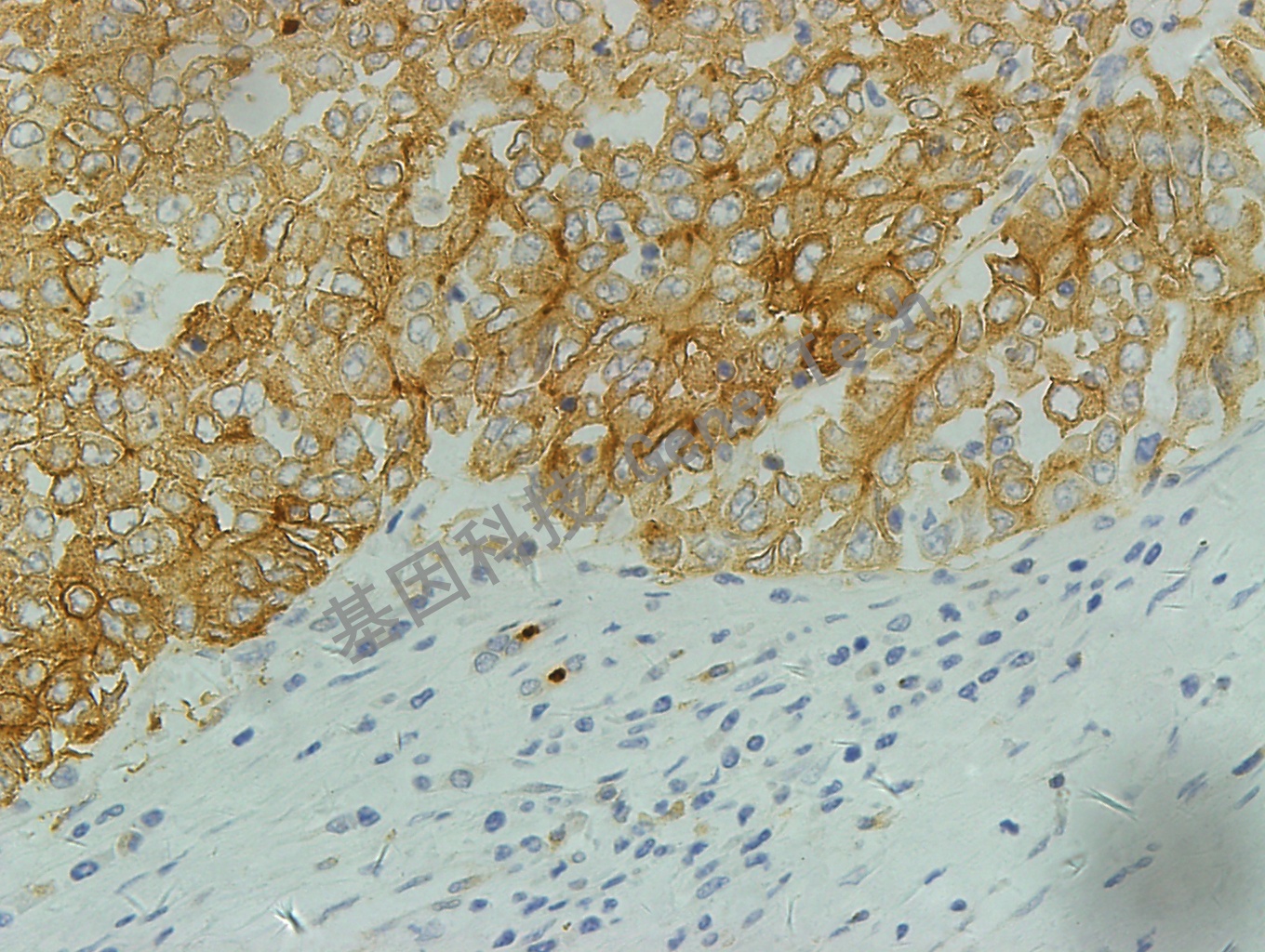 p170 GT2223 肝癌1 40X_副本.jpg