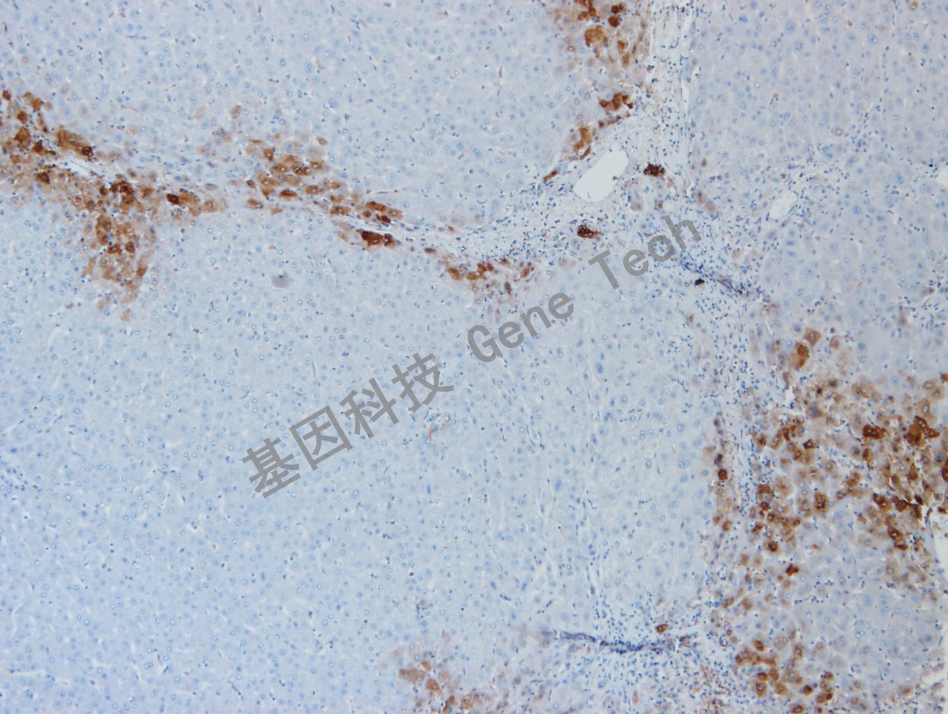 20191210-9 GLUL G10-3肝癌_副本.jpg