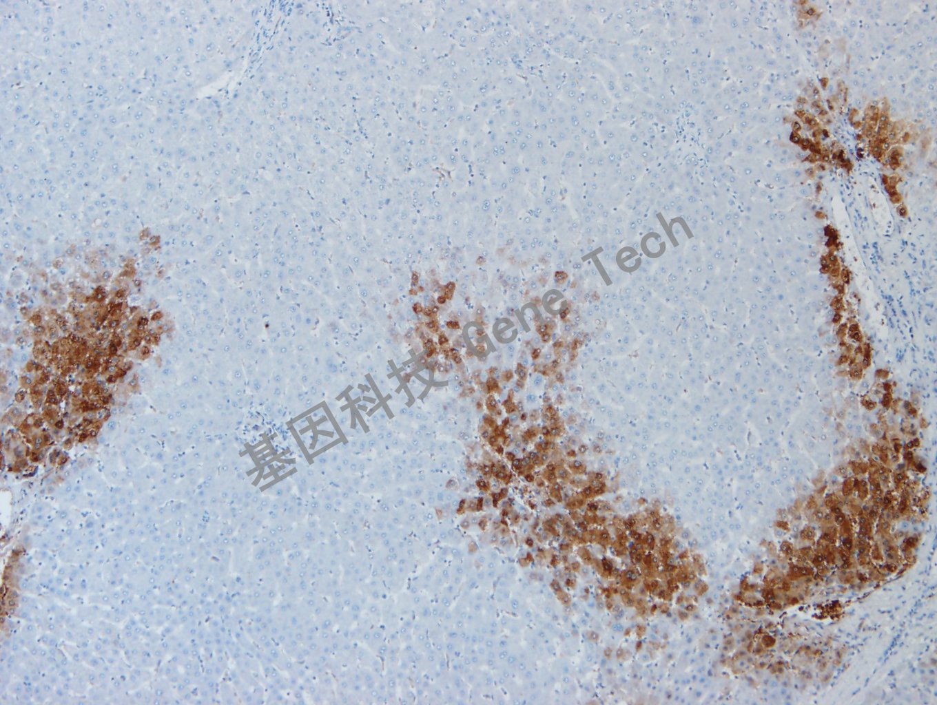 20191210-9 GLUL G10肝癌_副本.jpg