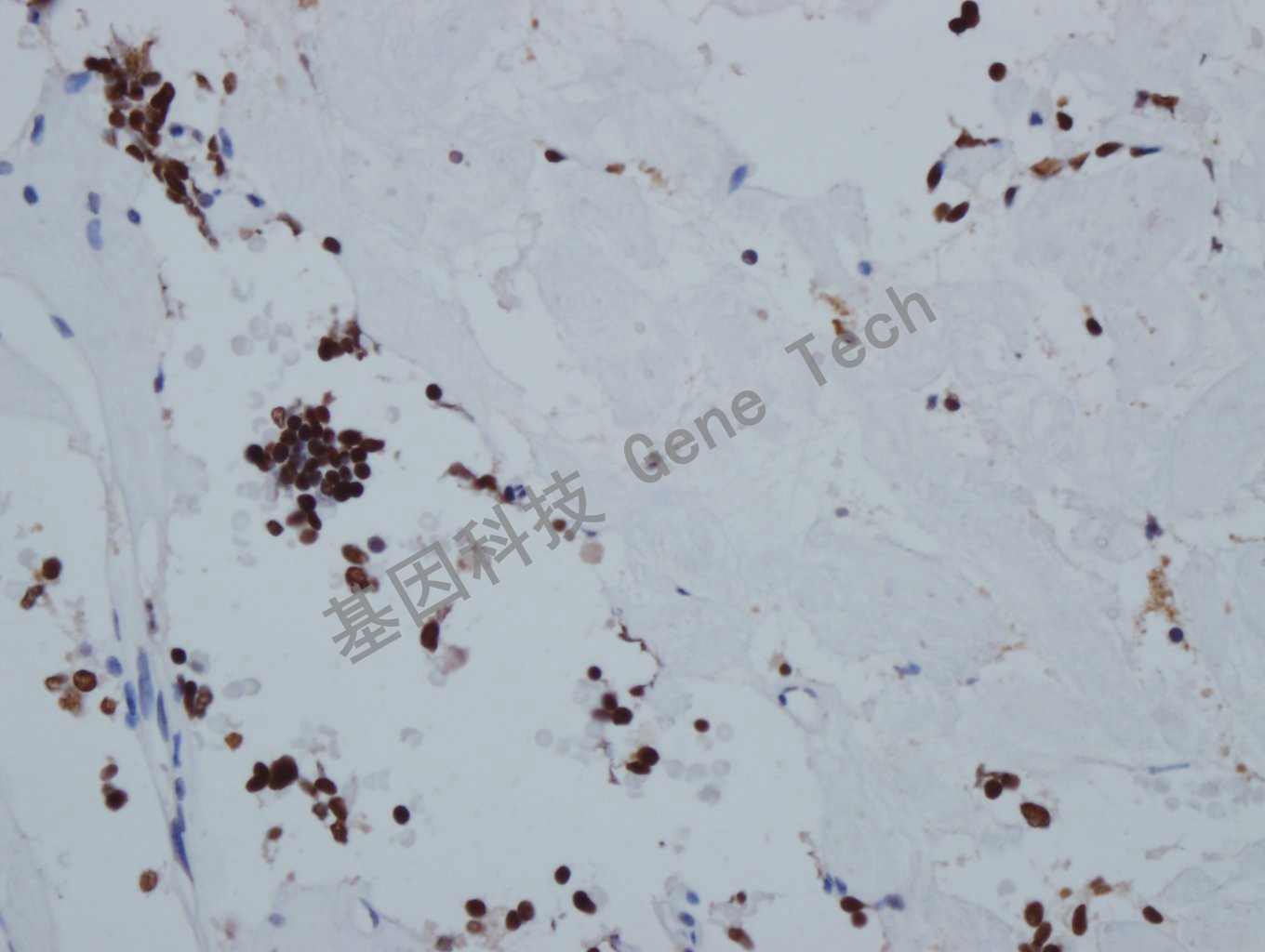 Pit1 垂体瘤-3_副本.jpg