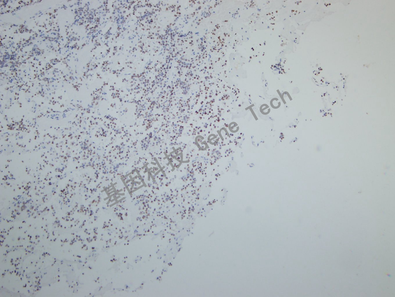 Pit1 垂体瘤-6_副本.jpg