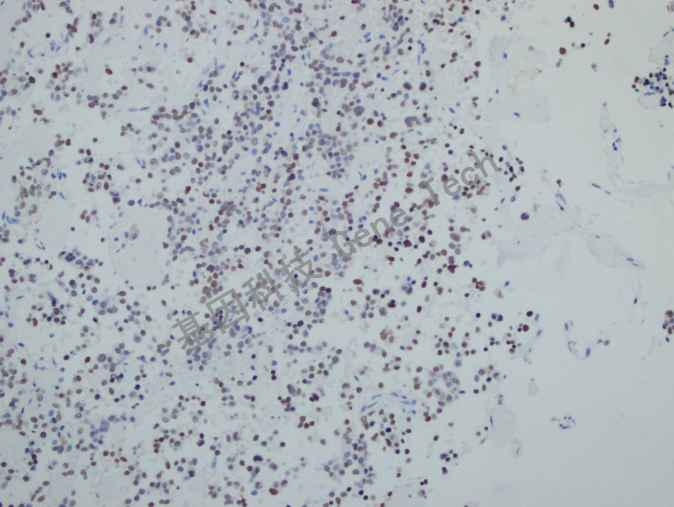 Pit1 垂体瘤-7_副本.jpg