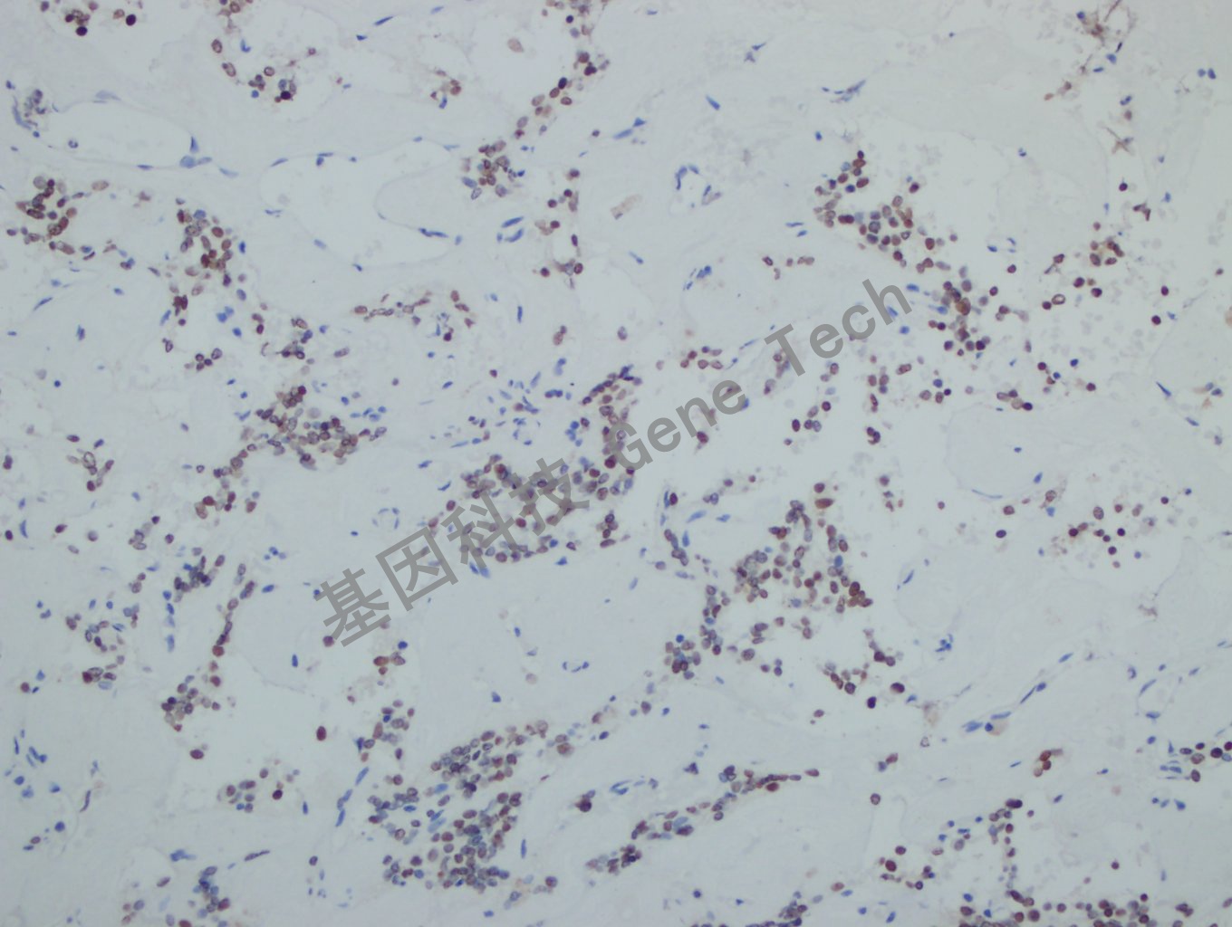 Pit1 垂体瘤-8_副本.jpg