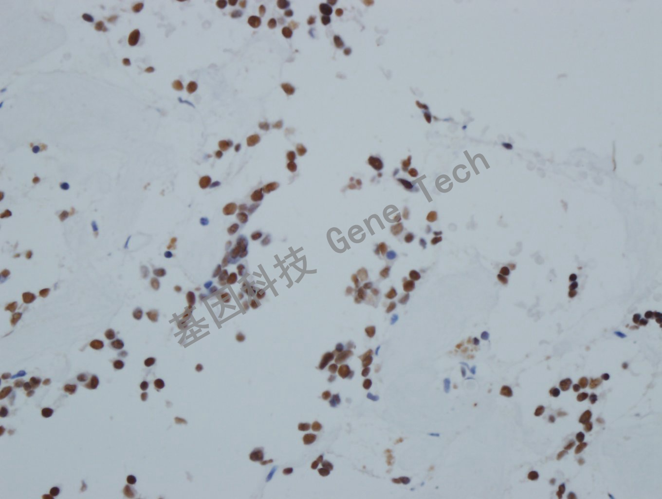 Pit1 垂体瘤-9_副本.jpg