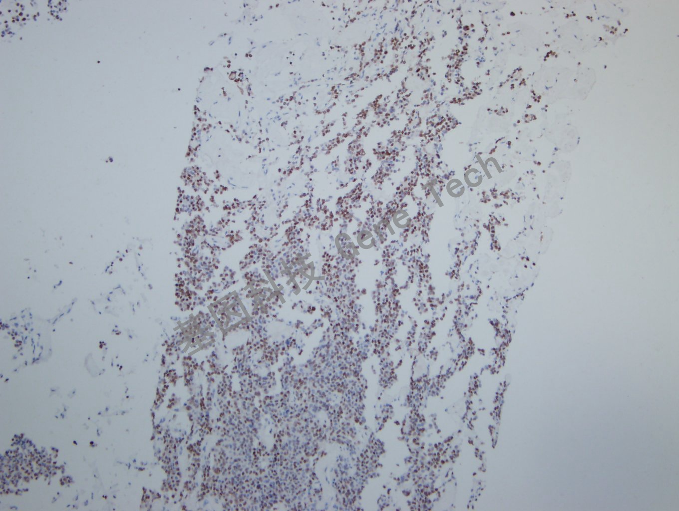 Pit1 垂体瘤-10_副本.jpg