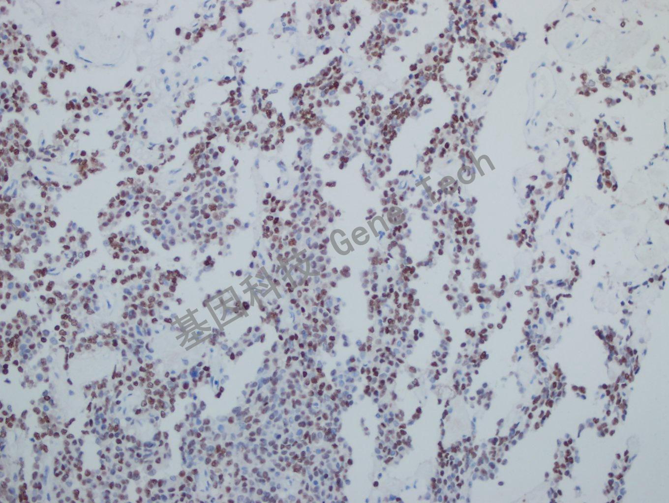 Pit1 垂体瘤-11_副本.jpg