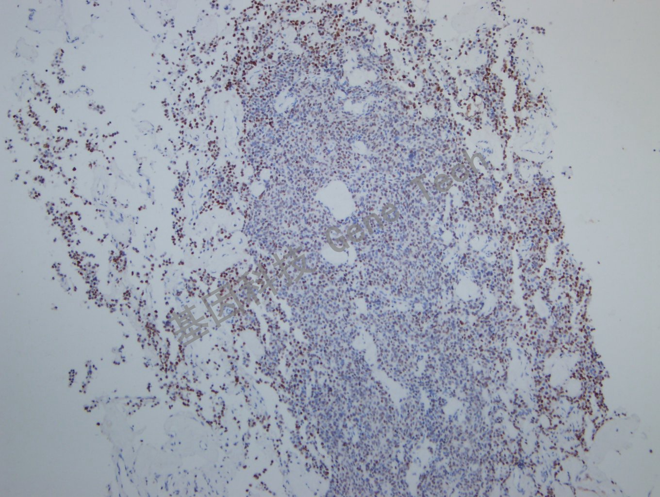 Pit1 垂体瘤-12_副本.jpg