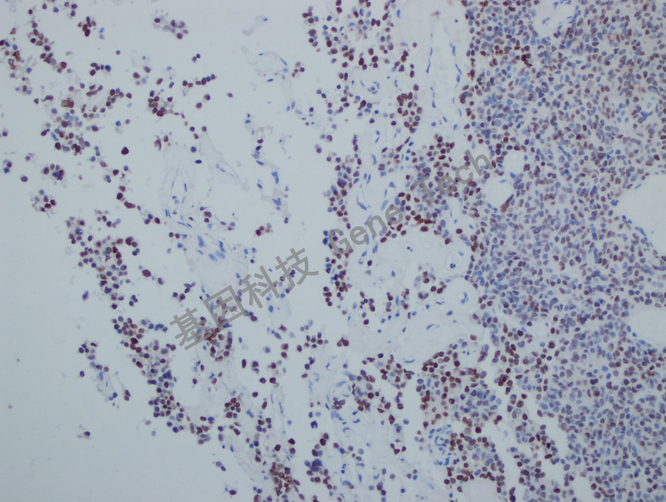 Pit1 垂体瘤-13_副本.jpg