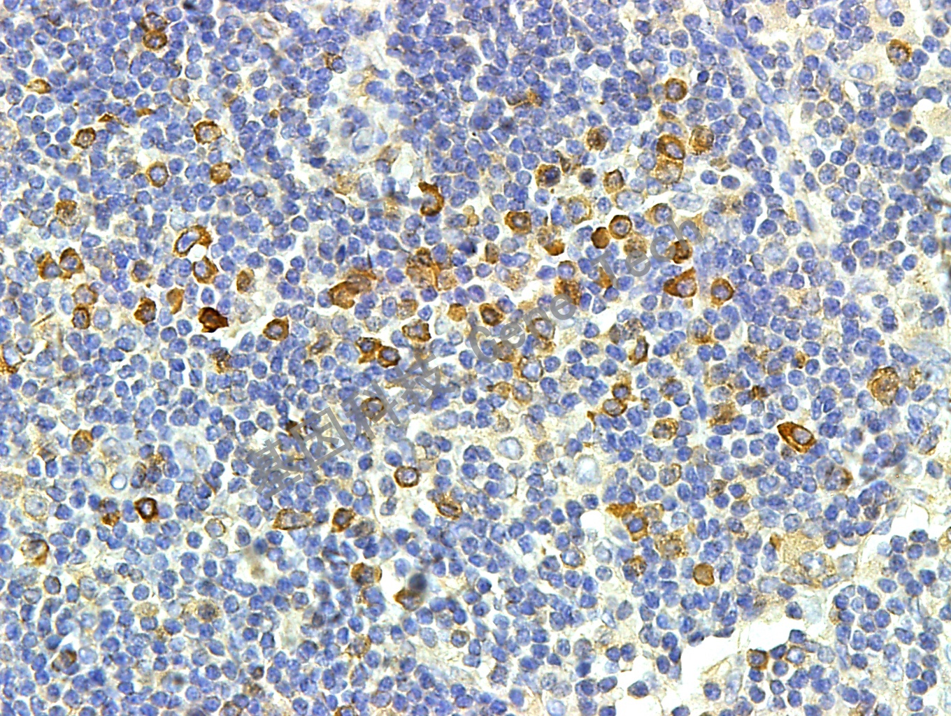 Plasma cell GT2132  淋巴结_副本.jpg