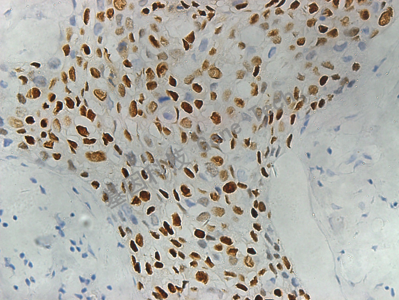 1595858761838345.jpg PR GT2057 乳腺癌4_副本.jpg