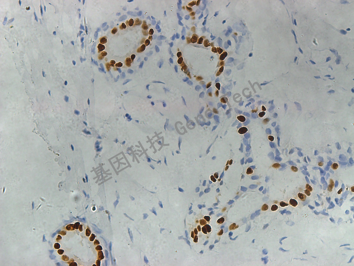 1595858769621637.jpg PR GT2057 乳腺癌6_副本.jpg