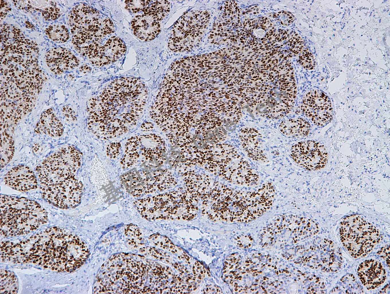 1595858786359014.jpg PR-2 GT2057 乳腺癌_副本.jpg