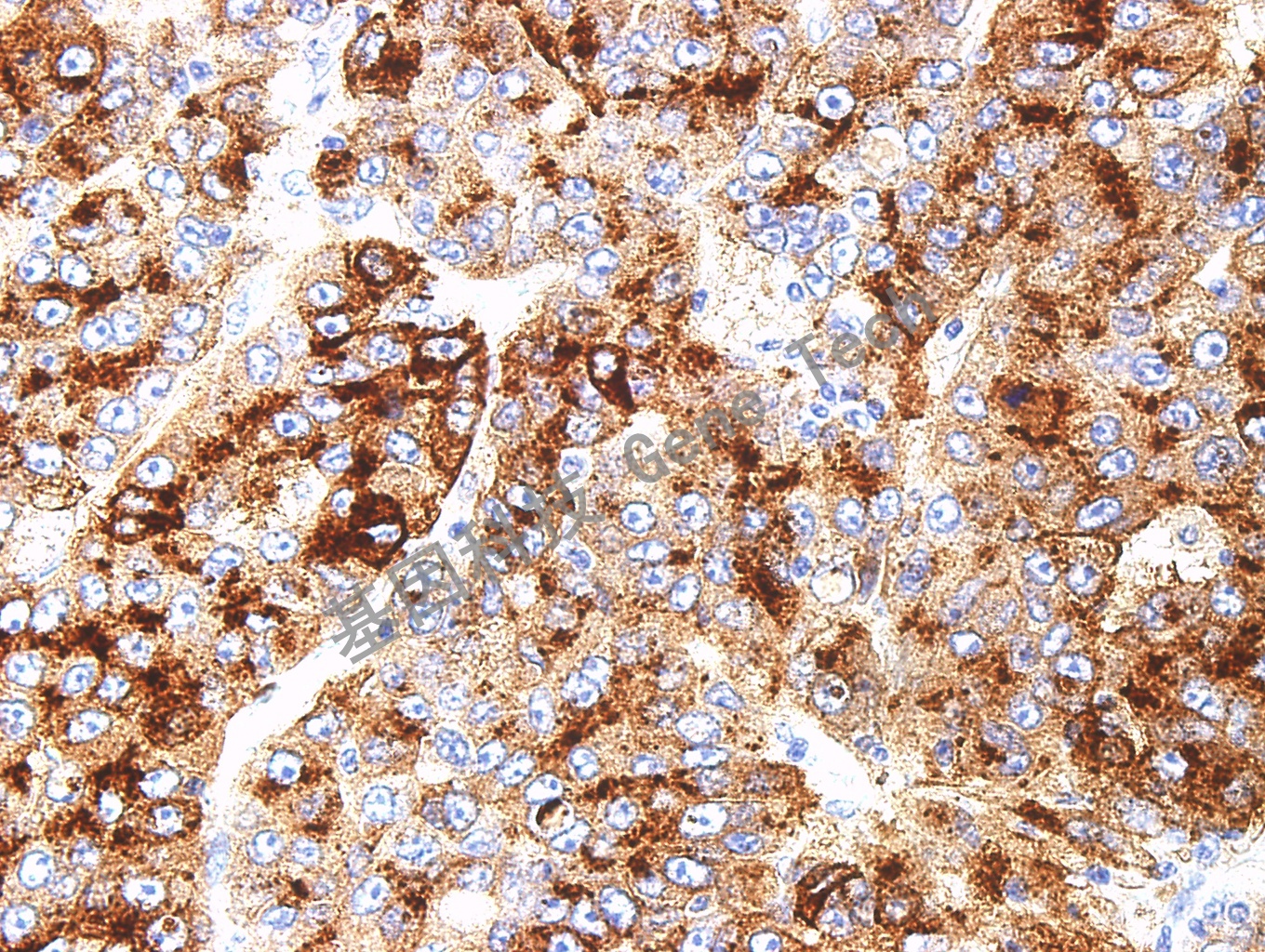 1596102542447831.jpg GLP3 GT2068 肝细胞癌2-40_副本.jpg