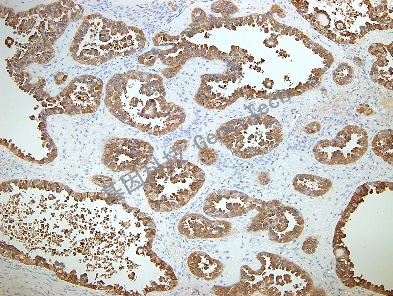 1596102551371321.jpg GLP3 GT2068 卵巢透明细胞癌_副本.jpg