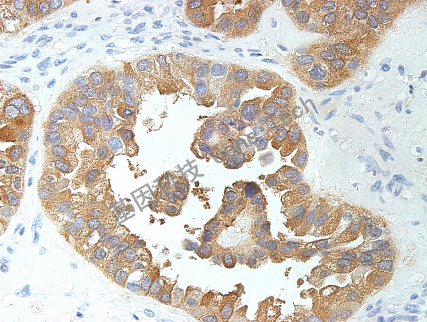 1596102559601885.jpg GLP3 GT2068 卵巢透明细胞癌40_副本.jpg