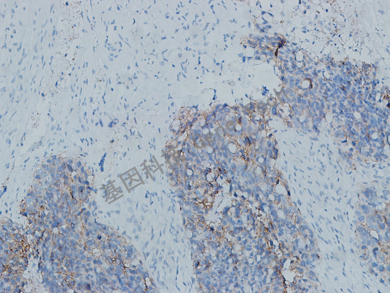 20200213-21 Claudin3 M3 浆液性卵巢癌-3_副本.jpg