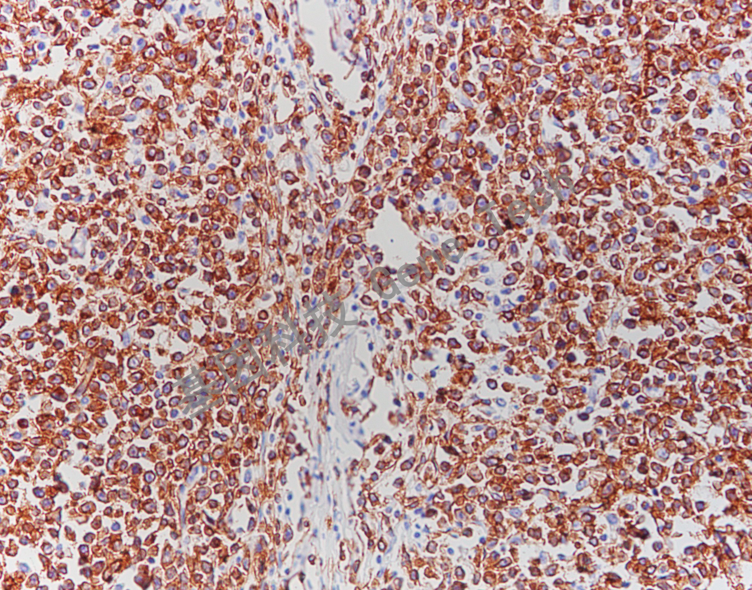 20180725-2 U7 淋巴瘤-2_副本.jpg