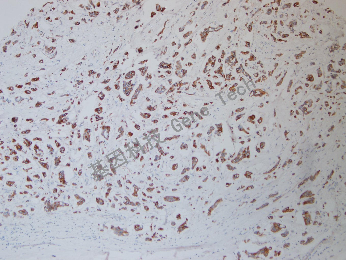 20200729-22 CK7 CK7-T4 乳腺癌3_副本.jpg