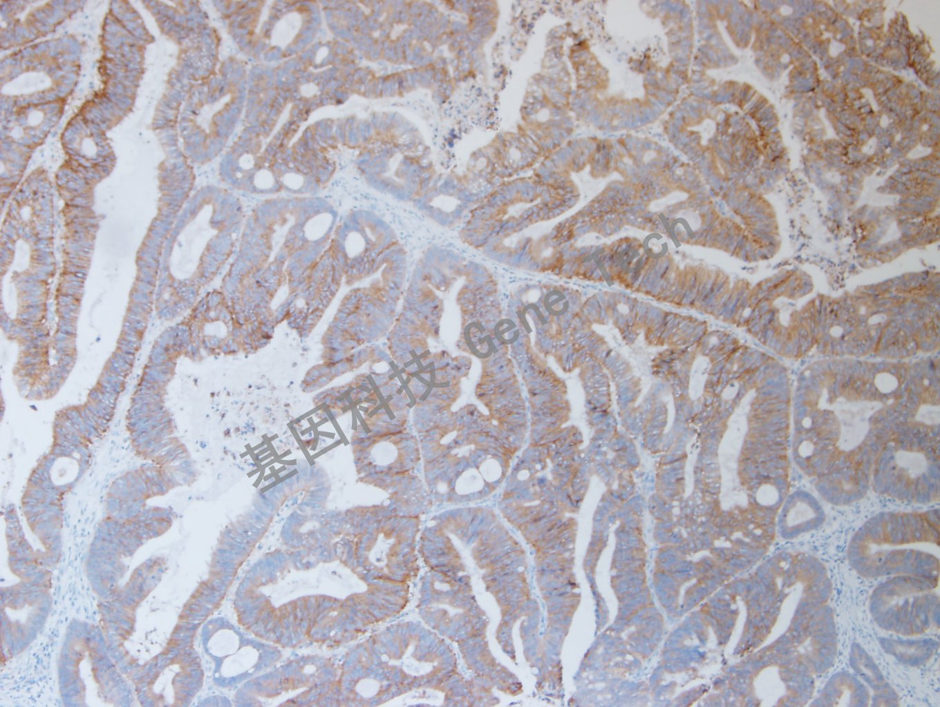 20200915-1 Claudin7 05-T6 结直肠癌2_副本.jpg