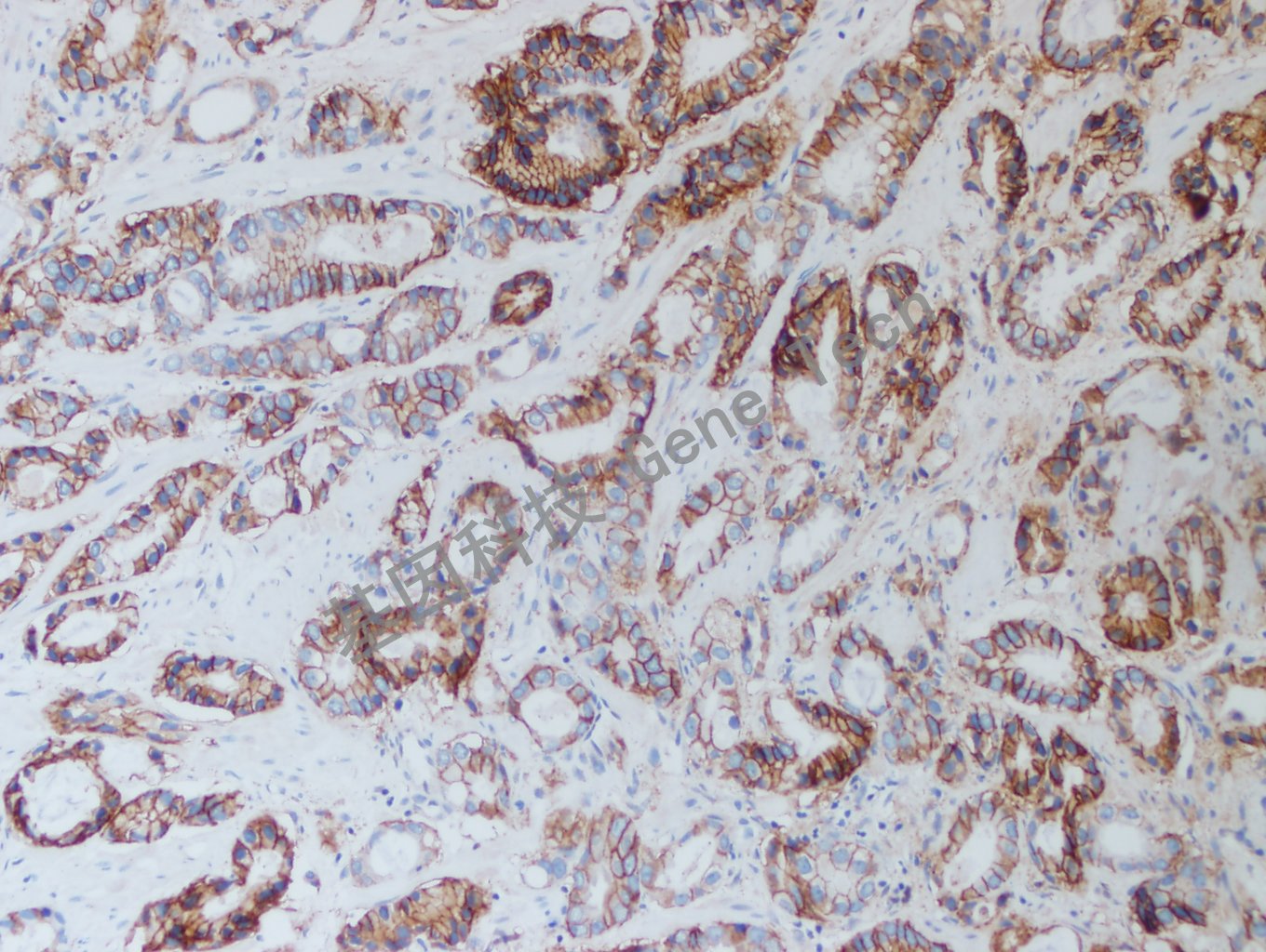 20200915-1 Claudin7 05-T6 前列腺癌2-2_副本.jpg