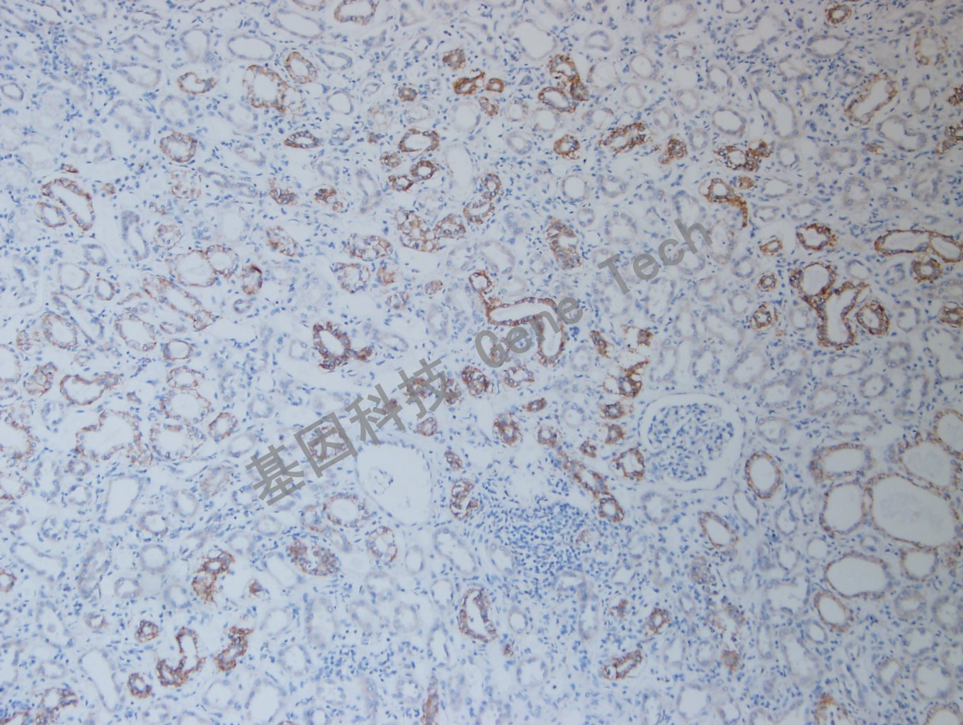 20200915-3 Claudin7 I3 肾癌_副本.jpg