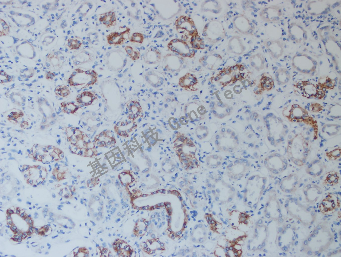 20200915-3 Claudin7 I3 肾癌-2_副本.jpg