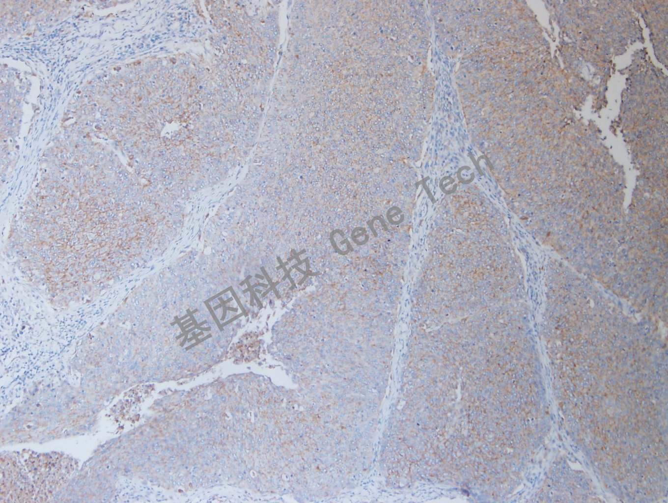 20200915-7 Claudin7 O6 宫颈癌_副本.jpg