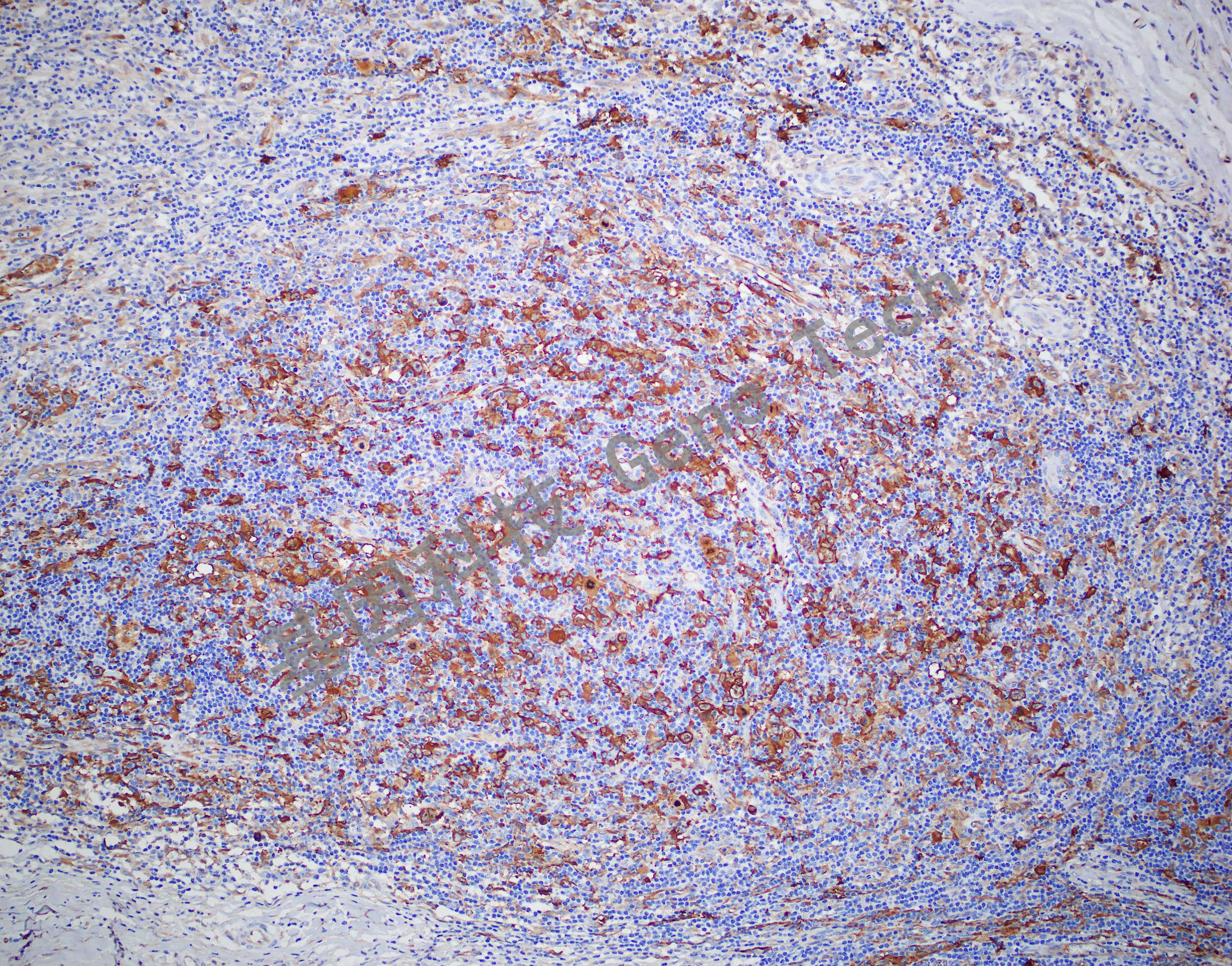 Fascin 霍奇金淋巴瘤 20210104-12 U28 -3_副本.jpg