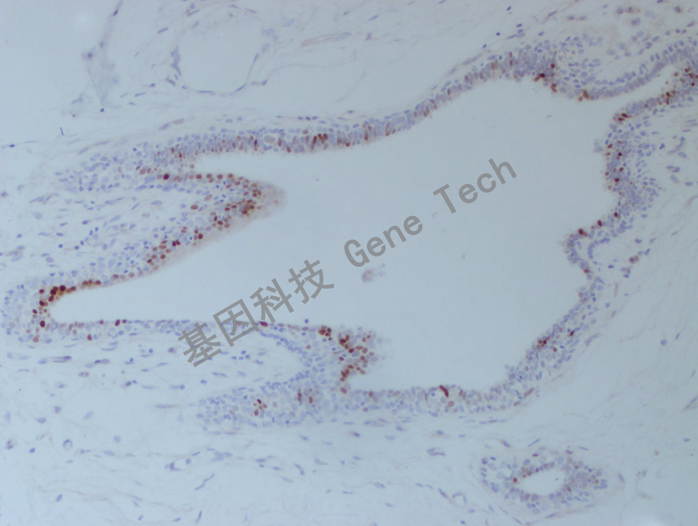 1626750930949754.jpg 20200902-46 FOSB C45 乳腺癌-2_副本.jpg