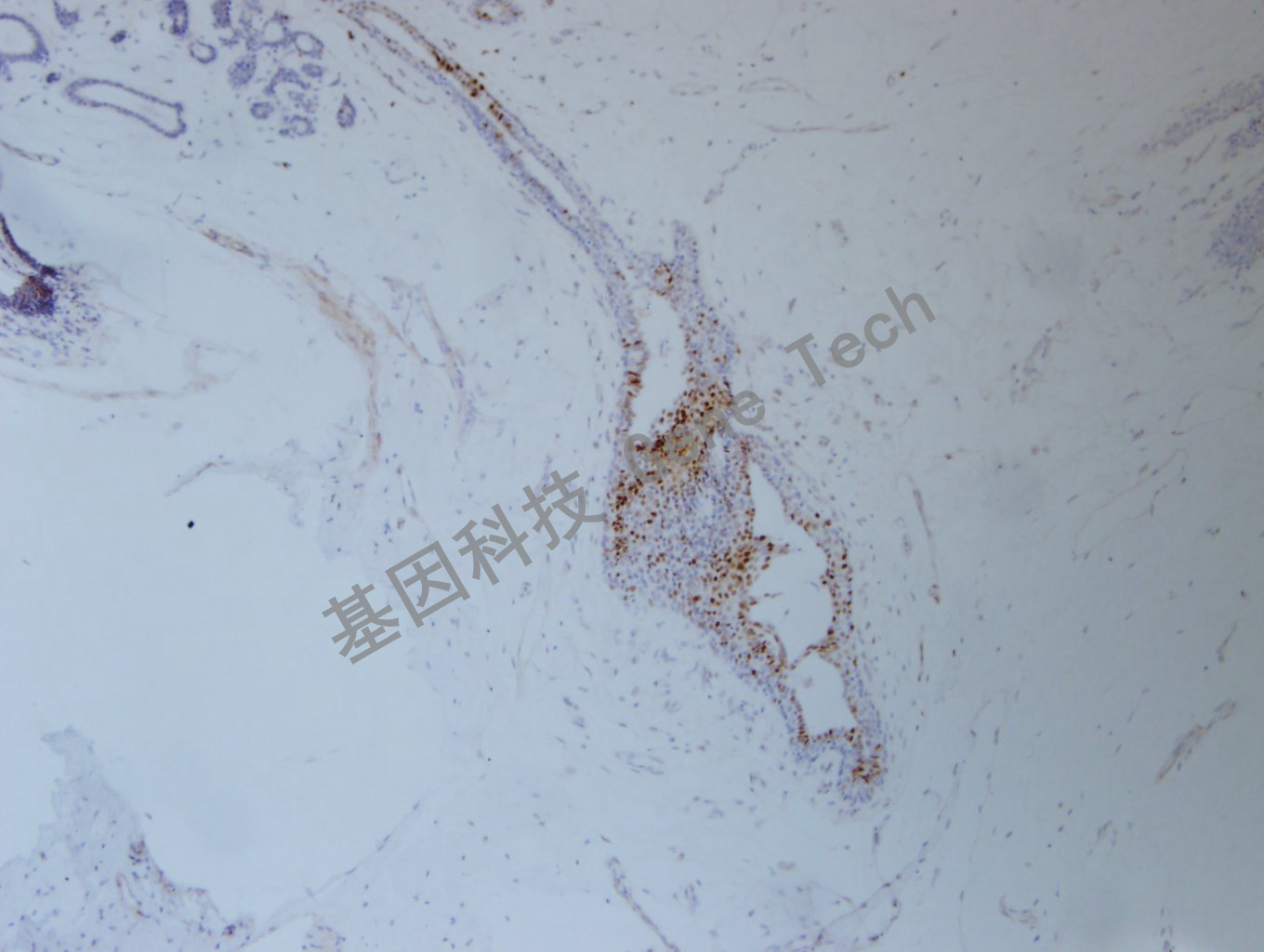 1626750965580455.jpg 20200902-46 FOSB C45 乳腺癌-3_副本.jpg