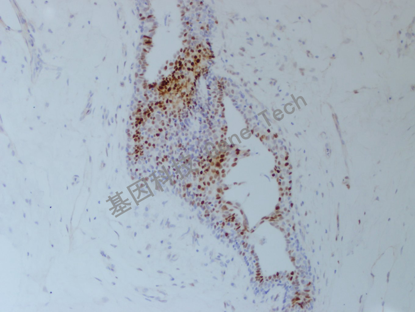 1626750996112885.jpg 20200902-46 FOSB C45 乳腺癌-4_副本.jpg