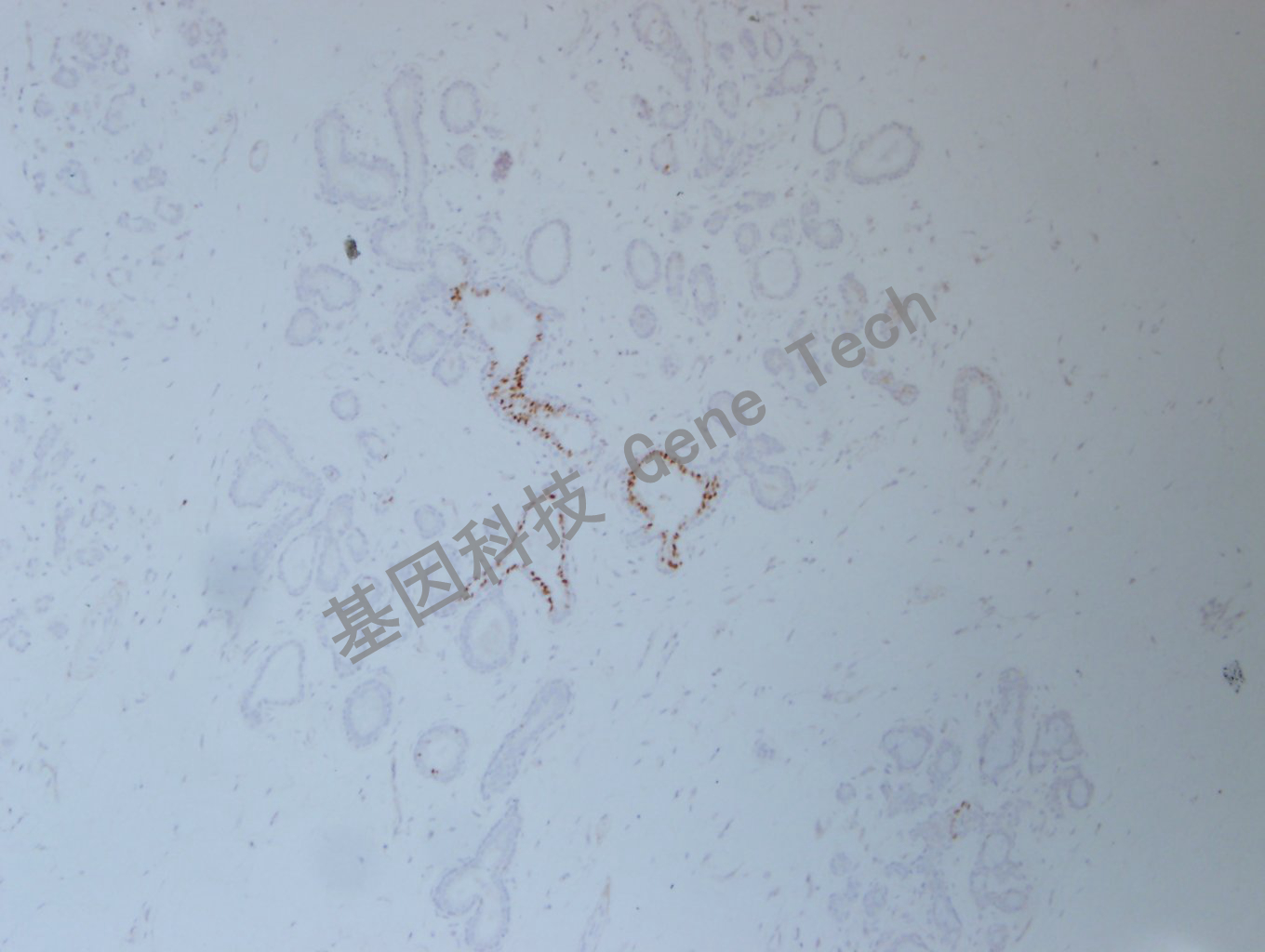 1626751016778444.jpg 20200902-46 FOSB C45 乳腺癌-5_副本.jpg