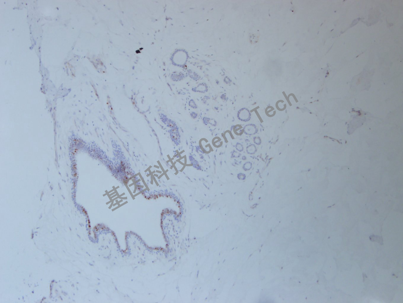 1626751030106503.jpg 20200902-46 FOSB C45 乳腺癌-6_副本.jpg