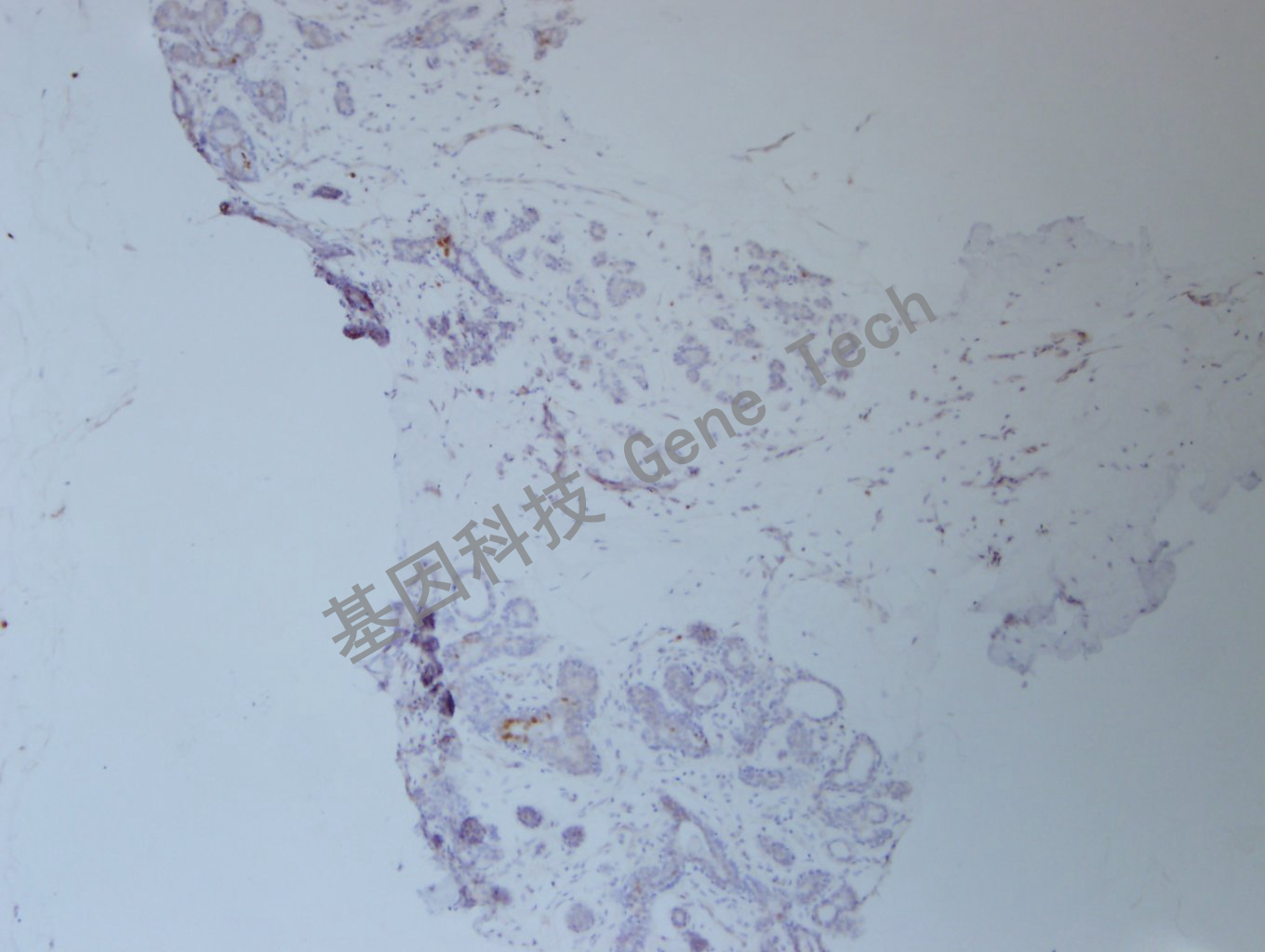 1626751044120166.jpg 20200902-46 FOSB C45 乳腺癌-7_副本.jpg