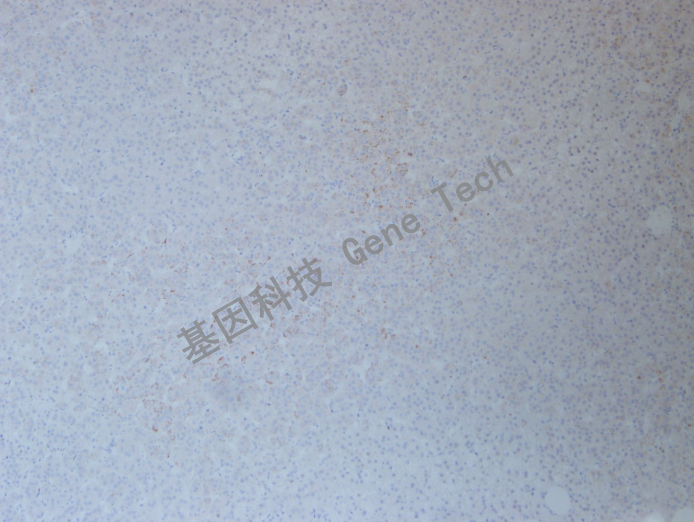 1626751539706452.jpg 20200902-48 FOSB BN3 肾上腺嗜铬细胞瘤_副本.jpg