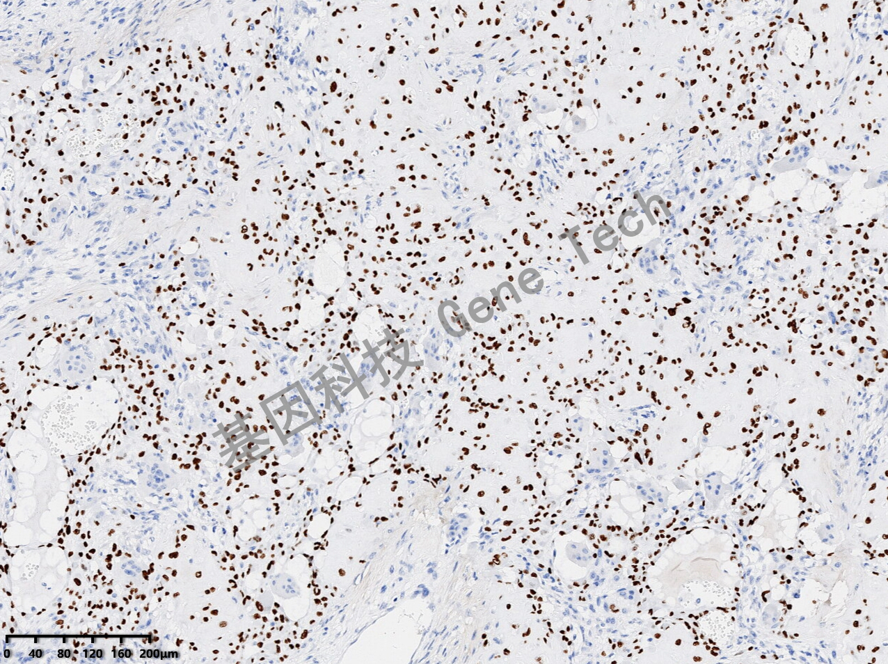 1626771963118982.jpg H3.3G34W 骨巨细胞瘤 20210108-39 BX4_副本.jpg