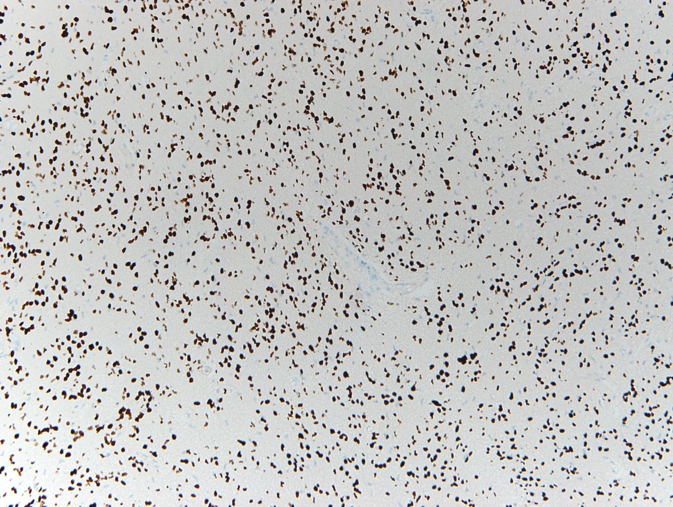 H3K27M  A95高级别胶质瘤H3K27M 90%+ H3K27Me3 20%+.jpg