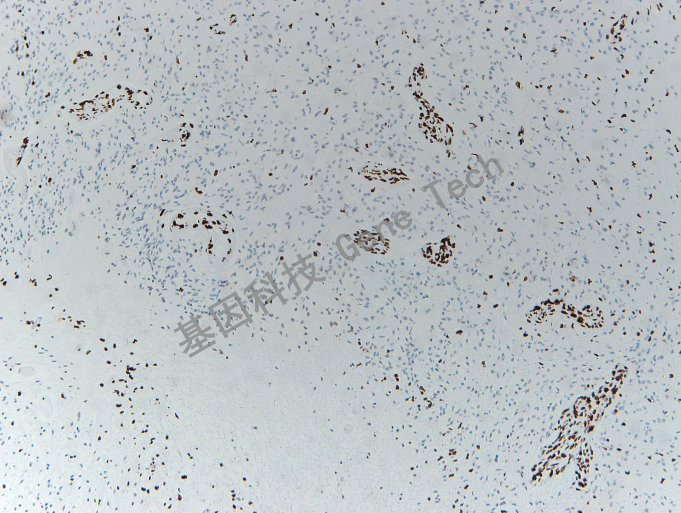 H3K27Me3 A95高级别胶质瘤H3K27M 90%+ H3K27Me3 20%+ 20200410-8_副本.jpg