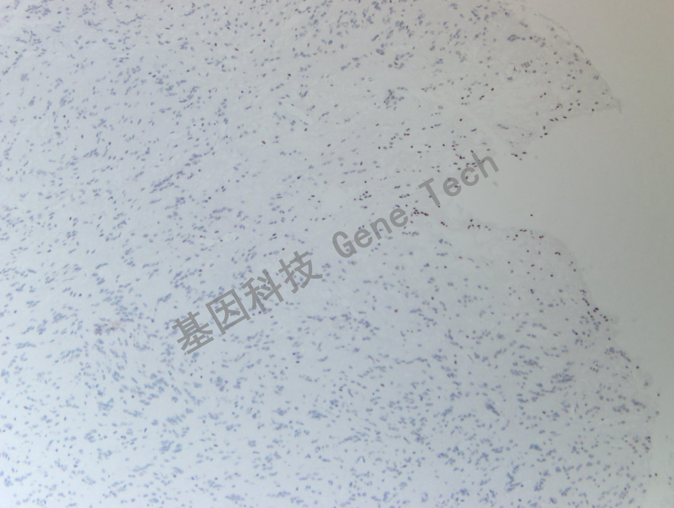 20200513-16 H3K36M 24-T BI4-3胶质瘤_副本.jpg