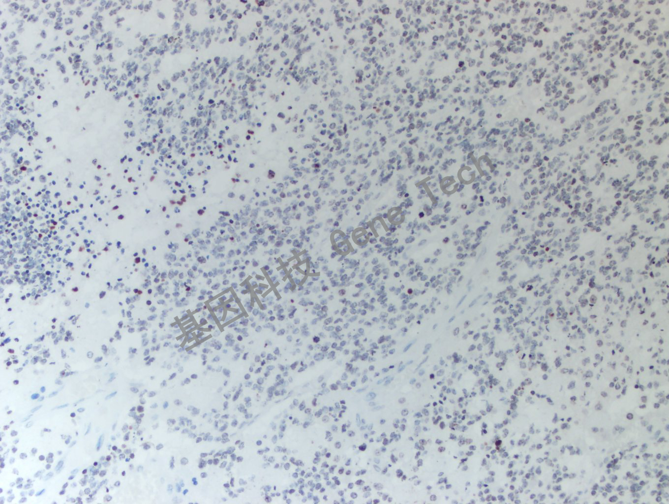 20200513-16 H3K36M 24-T BI5-2胶质瘤_副本.jpg